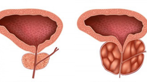 Prostatavergrösserung